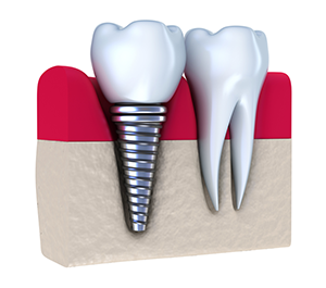 Dental Implants Dr. Paul J. | Tronsgard and Dr. Daren T. Sullivan